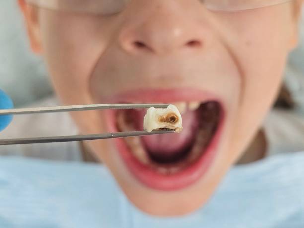 Best Emergency Wisdom Teeth Removal in Sumas, WA
